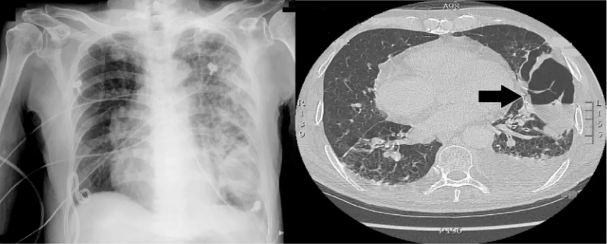 Figure 4.  Left lung pneumonia progressed to necrotizing pneumonia with air-fluid level (arrow) (day  18)