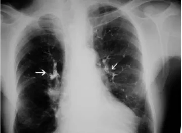 Figure  1.  Chest  radiography  showed  multiple  high- high-density  tubular  opacities  outlining  pulmonary  vessels  (arrows).