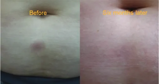 Figure 2  (Left) A bean-sized tender erythematous subcutaneous nodule on the lower abdomen