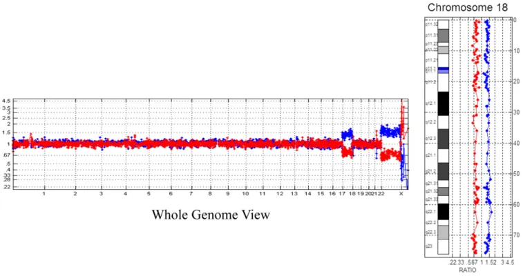 Fig. 3. Bacterial artificial chromosomeebased array comparative genomic hybridization in Case 2 shows a duplication of chromosome 18 consistent with the diagnosis of trisomy 18.