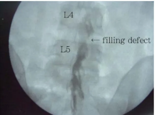 Fig 3. Anteroposterior view of correct placement of the catheter with confirmation by dye spread