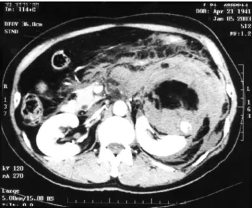 Fig. 4. This shows that an adipose-containing mass with huge perirenal hematoma and contrast pooling, measured 10 ⫻ 10 cm, on the upper pole of the left kidney.