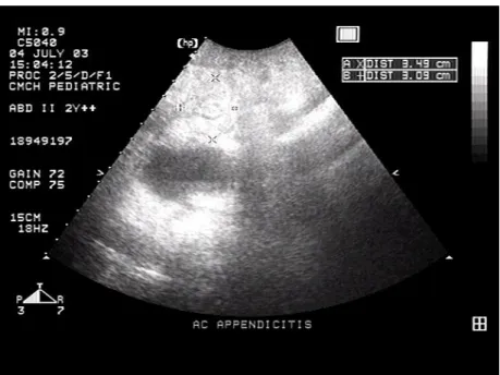 Figure   1  Sonographic   image   shows   the   transverse   section   of   an   acutely   inflamed appendix with an 11-mm  outer  diameter