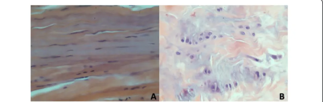 Figure 1 Features of A1 pulley in normal and trigger finger. (A) Normal A1 pulley tissue with pink collagen deposits and fibrocytes with elongated nuclei; (B) Trigger finger A1 pulley tissue, presence of chondroid metaplasia with a blue-color chondromyxoid