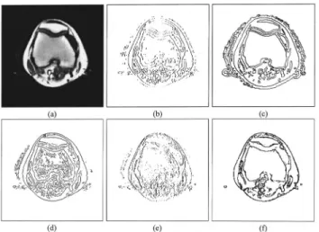 Figure 9 共a兲 is a CT head image in which a number of tiny tissues exist. Figures 9 共b兲 and 9共e兲 show the edge  de-tection image using the Laplacian-based and wavelet-based methods, respectively