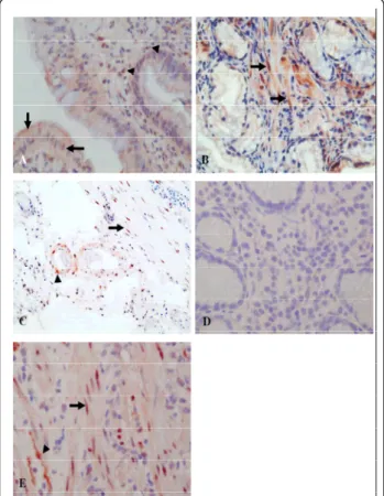Figure 1 Representative immune-histochemical staining of SRF expression. (A) High nuclear and cytoplasmic SRF intensity of regenerative epithelial cells (arrow), some mononuclear inflammatory cells and myofibroblasts (arrowhead) of the lamina propria in ga