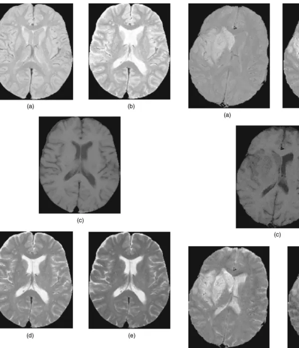 Fig. 5 Multispectral MR head images with cerebral infarction: (a) TR 1 /TE 1 ⫽ 2500 ms/25 ms, (b) TR 2 /TE 2 ⫽ 2500 ms/50 ms, (c) TR 3 /TE 3 ⫽ 500 ms/20 ms, (d) TR 4 /TE 4 ⫽ 2500 ms/75 ms, and (e) TR 5 /TE 5 ⫽ 2500 ms/100 ms.