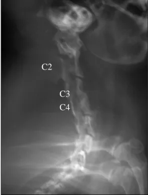 Fig. 3: C3-C4 discectomy with interbody bone fusion                                                                C2                                                       C3                                            C4 F