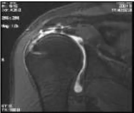 圖 1-3、MRI 影像(complete supraspinatus tears, Coronal Oblique views) 
