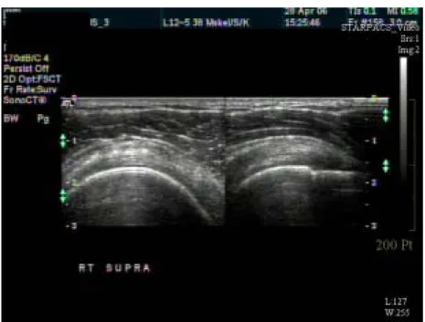 圖 2-2、右圖為肌腱炎之長軸影像。左圖為短軸影像 