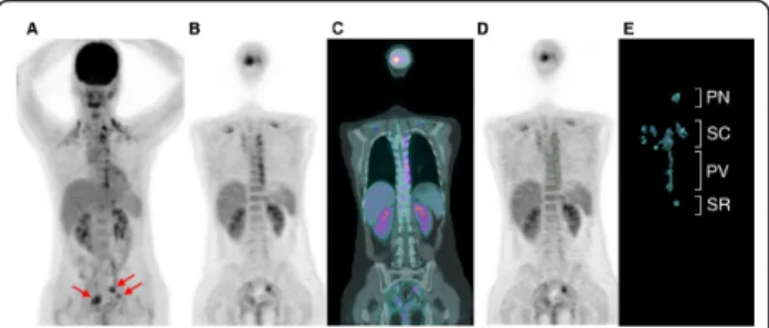 Figure 1 18F-FDG PET/CT scan of a 33-year-old woman with a history of cervical cancer treated with a radical hysterectomy: