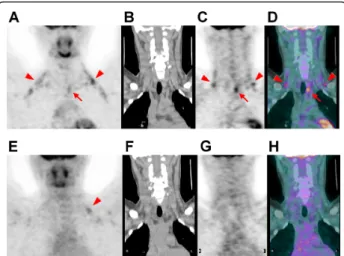Figure 3 18 F-FDG PET/CT scan (top row) of an 18-year-old man with a history of papillary thyroid cancer treated with a bilateral total thyroidectomy showing activated BAT deposits in the bilateral posterior neck (PN) and supraclavicular (SC) areas (arrowh