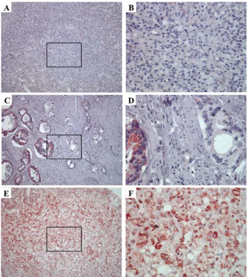 Figure 1. ASS expression in gastric cancer. Immunohistochemical staining to determine the distribution of ASS‑positive cells (red color) was performed on  paraffin‑embedded specimens from AJCC stage I (A and B), stage II (C and D), and stage III (e and F) 
