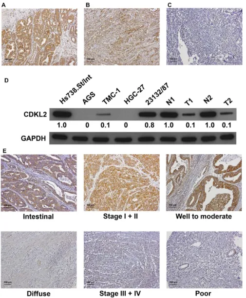 FIGURE 1  CDKL2 expression in  gastric tissues and cell lines. Panels A to  C. Gastric tissue specimens analyzed by  immunohistochemistry with an antibody  against CDKL2