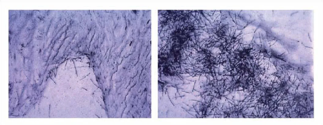 Fig. 2 . Microautoradiography from a dog injected with an a-emitting bone seeker. Distribution of a-particle tracks in normal spongious bone (A, left) and an osteoblastic zone (B, right).