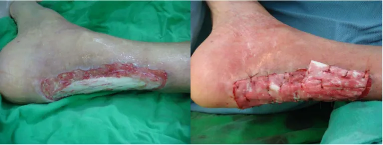 Fig. 2.  Two pieces of  5*5 cm sized artificial dermis was  applied to the lesion suturing by 4-0 catguts
