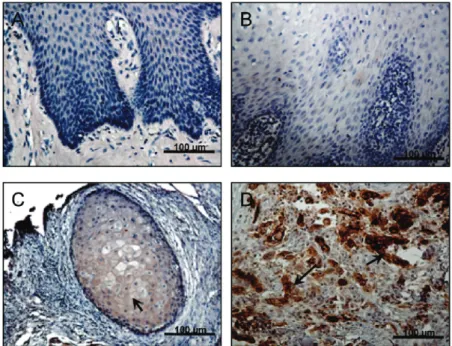 Figure 1. Detection of L1CAM protein in OSCC patient tissues. Representative images (200 ×; scale bar )100 µm) of immunohistochemical staining of L1CAM in OSCC tissues
