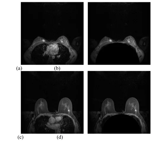 Fig. 8.  (a)(c) Original MR images, and (b)(d) the results of removing the area of the thoracic cavity for ROI extraction