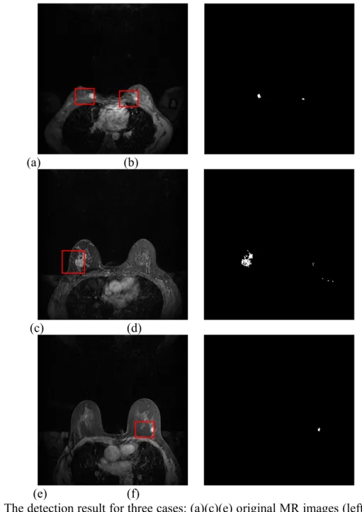 Fig. 10.  The detection result for three cases: (a)(c)(e) original MR images (left) and (b)(d)(f) detection results (right)