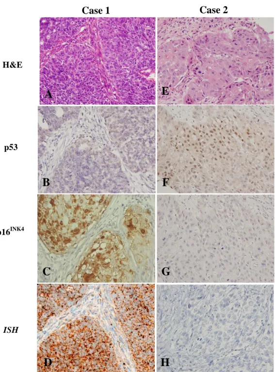 FIGURE 2. The microscopic illustrations with comparisons of two representative cases of OSCC were  shown in left panel from A-D (case 1) and right panel from E-H (case 2)