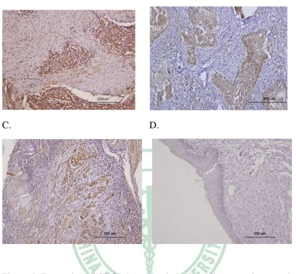 Figure 5. Expression of CXCR4 proteins in human primary oral cancer tissue    A, Strong CXCR4 expression was observed in tumor cells