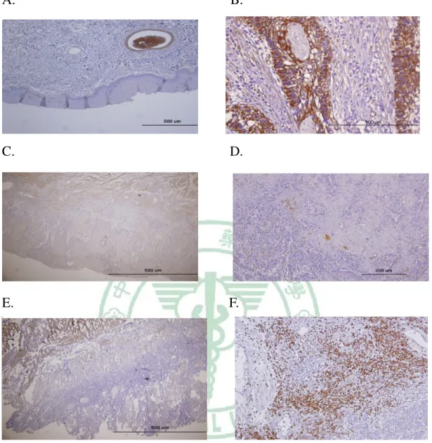 Figure 6. Expression of SDF-1 proteins in human primary oral cancer tissues.   