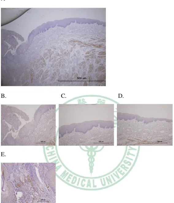 Figure  7.  SDF-1  involved  in  the  tumorigenesis  of  OSCC.  A,  In  one  special  case,  we  observed  the  OSCC  developing  since  normal  epithelia  in  the  right  side progressed to malignant cells in the left view