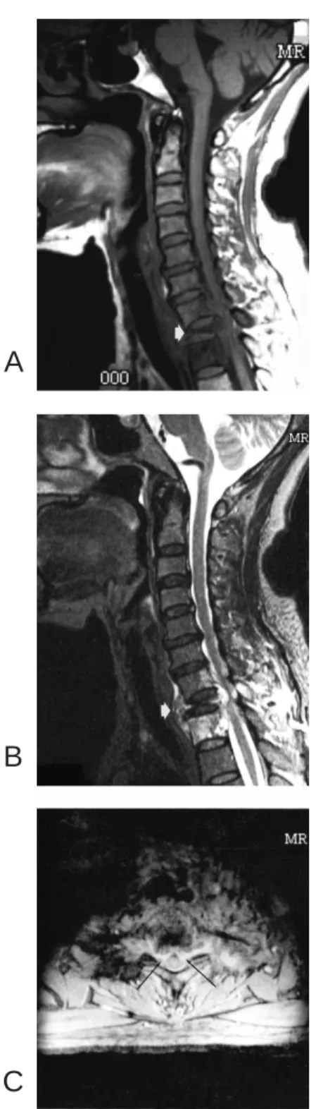 Fig. 1. A: Sagittal T1-weighted MR image of cervical spine shows pathologic compression fracture at T1 vertebral body (arrow) and replacement of fatty marrow by low signal intensity tumor at the C7, T1 and T2 vertebral bodies