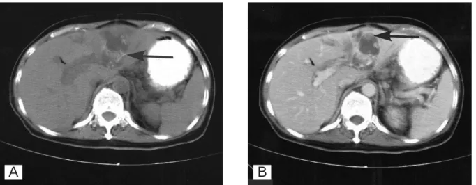 Fig. 6. A: Pre-contrast abdominal CT scan shows a low attenuated mass with amorphous calcification (arrow) in the left lobe of the liver and intrahepatic ductal dilatation