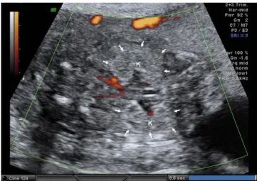 Fig. 2. Prenatal ultrasound at 21 weeks of gestation shows bilateral enlarged echogenic kidneys (K) (arrows) consistent with polycystic kidneys.