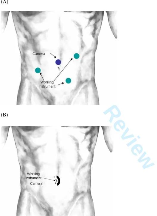 Figure 1-(A) Schematic of conventional laparoscopy port placement for right hemicolectomy; 