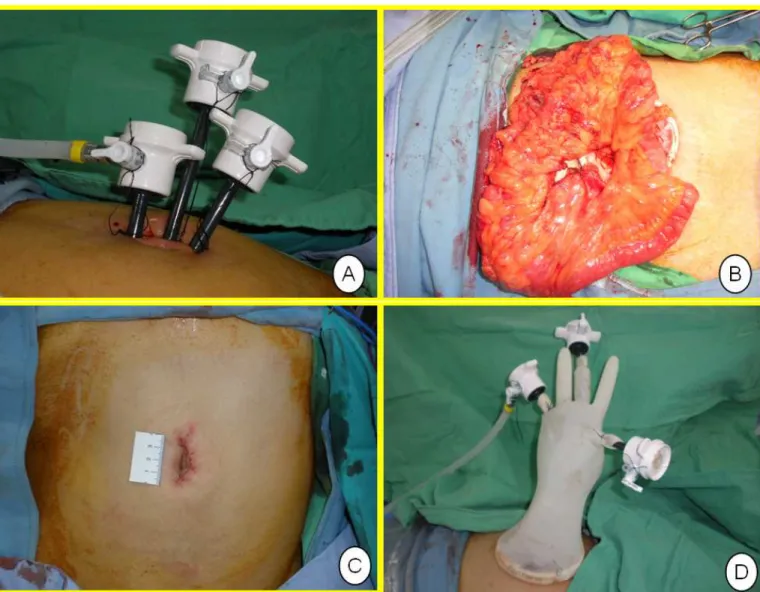 Figure 2-(A) SILS port placement for right hemicolectomy, and the adjacent three trocars  stand on different height