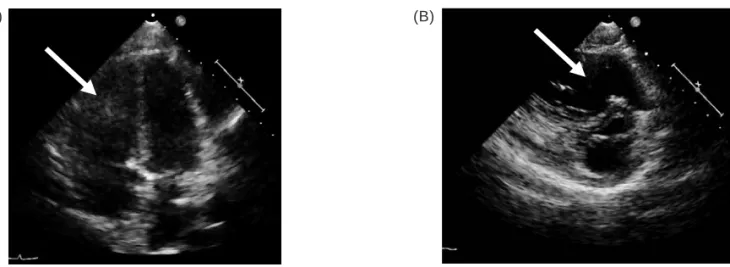 Figure 1. (A) Four-chamber view of the patient’s echocardiogram. (B) Short-axis view of the patient’s echocardio- echocardio-gram