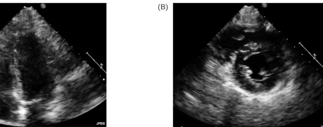 Figure 2. (A) Four-chamber view of the patient’s echocardiogram. (B) Short-axis view of the patient’s echocardio- echocardio-gram