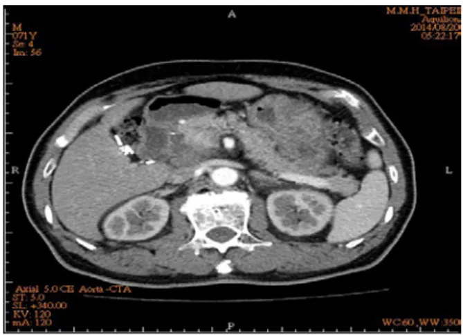 Figure 1. A 5cm heterogeneous soft tissue mass occu- occu-pied at right para-aortic region with anterior  displacement of duodenum and pancreas  head.