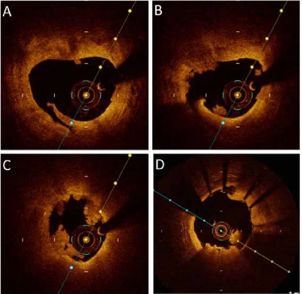 Figure 2. Example of a patient admitted for myocardial infarction and optical coherence tomography showed a super- super-ficial ruptured plaque (A) and white thrombus (B,C)