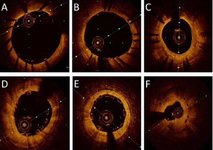 Table 2 summarize comparisons of Character- Character-ization of Pathology Using OCT and IVUS.