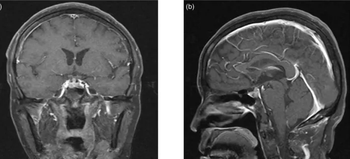 Figure 1. MRI image of the patient: (a) Coronal image of the Gadolinium-enhanced T1-weighted magnetic reso- reso-nance imaging scan of the brain showed: contrast-enhanced nodular lesion in the pituitary stalk, suggesting  metastasis