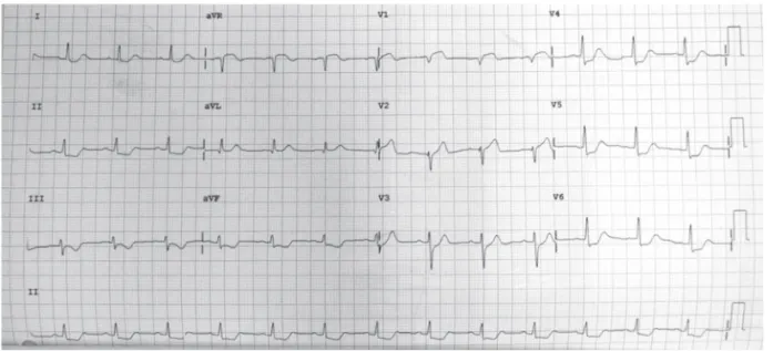 Figure 2. ST segment elevation in the aVR and V1 leads with diffuse ST segment down-sloping in the other leads.