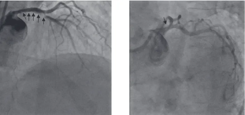 Figure 3. The dissected flap from LMCA to proximal LAD with compromised antegrade blod flow (arrow).