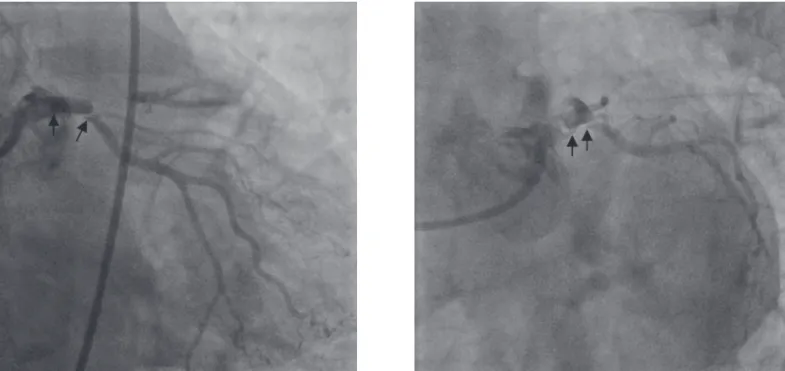Figure 5. Good left coronary artery distal run-off was  achieved after Cullotte stenting (arrow).
