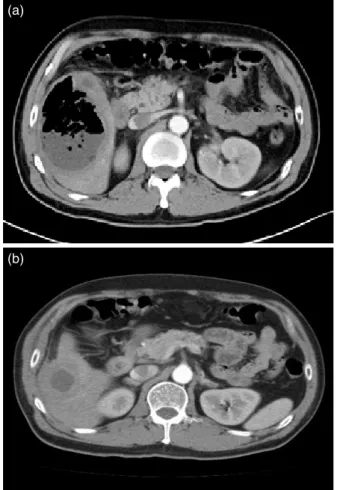 Figure 2. (a) Abdominal CT performed 14 days after  TACE showed a large gas forming abscess; 