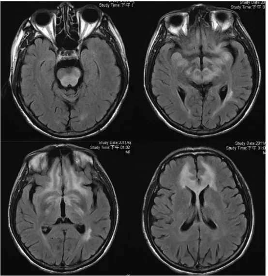 Fig. 1.  The FLAIR images of brain magnetic resonance imaging showed symmetric subcortical hyperintensity in bilateral  frontotemporal and basal ganglia, dorsal pontine, and midbrain.