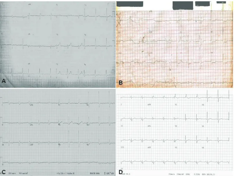 Figure 1.  A series of changes of 12-lead electrocardiograms in our patient. Before (A) and after (B) acute inferior  myocardial infarction electrocardiograms show a new Q-wave development (B) in inferior leads