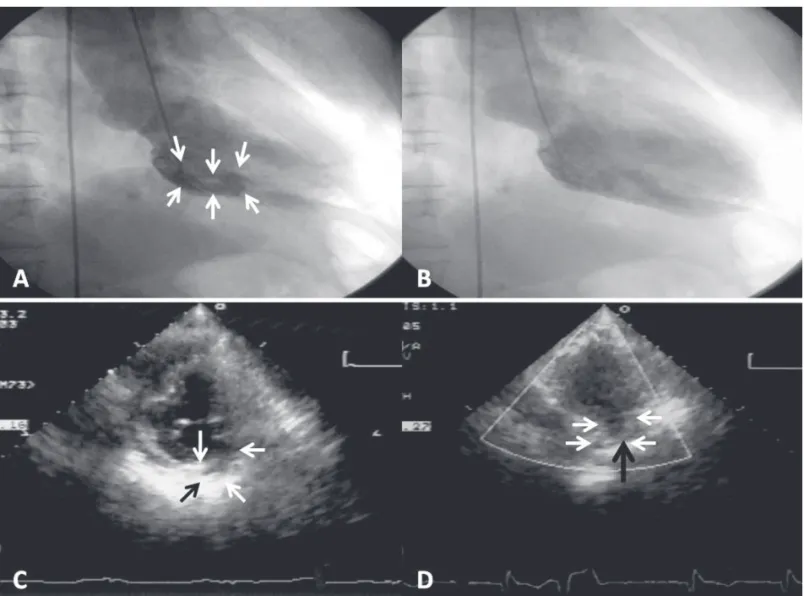 Figure 2.  Left ventriculograms (upper panels) and the follow-up transthoracic echocardiograms (lower panels) of our  patient, who developed a basal inferoposterior pseudoaneurysm after inferior myocardial infarction