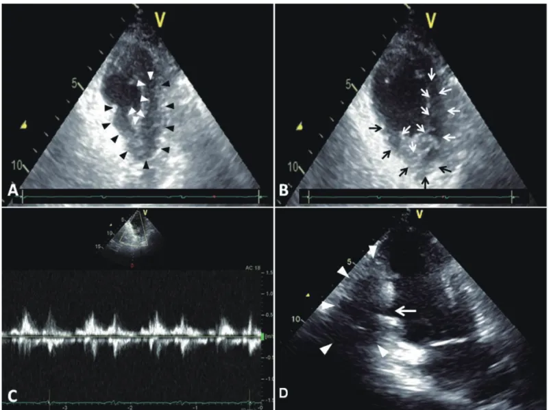 Figure 3.  The  most  recent  follow-up  transthoracic  echocardiograms.  The  parasternal  short-axis  views  at  the  end-systolic phase (A) and end-diastolic phase (B) show an tubular-like echo-free space posterior to the  inferoposterior wall (pseudoan