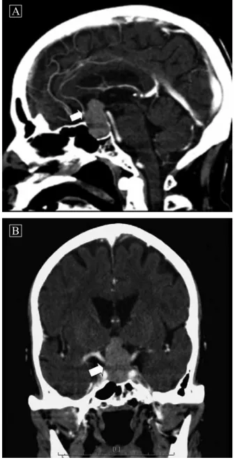 Figure 1.  Axial view of computed tomography of brain  revealed a huge tumor mass of 3.3x2.0x1.9  cm over the pituitary gland with suprasellar  extension (white arrow).