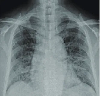 Fig. 1. Cytomegalovirus pneumonitis. Bilateral reticulo- reticulo-interstitial  infiltrations  especially  at  lower  lung  ﬁelds shown in chest X-ray ﬁlm.