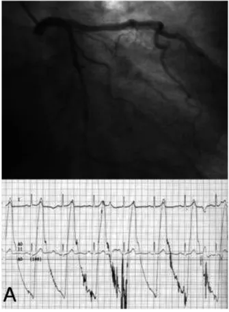 Fig. 2.  (A) Coronary angiography revealed mild st- st-enosis (30%) of the proximal segment of the  LAD, 50% stenosis of the distal segment of  the LAD, and 50 % stenosis of the circumﬂex  middle segment