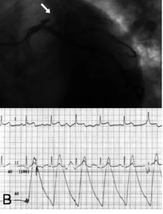 Fig. 2.  (C) Right coronary arteriography revealed mild  stenosis (30%) in the proximal segment of the  RCA.